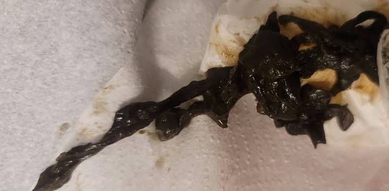 A long dark mucus-like strand laid out on white paper towels